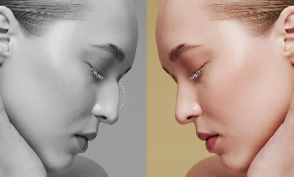 rhinoplastic Markov
