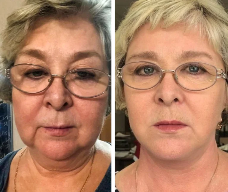 женщина после пластики лица
